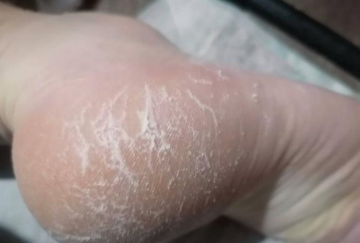 腳底死皮原因全解析：從日常習慣到健康問題深度探討