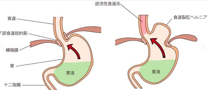 胃食道逆流自然療法