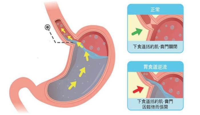 胃食道逆流自然療法