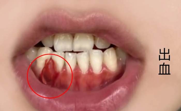 牙齦出血是癌症前兆？專業醫師解析原因與應對方法
