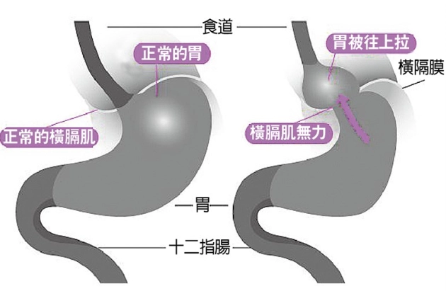 胃食道逆流中醫治療