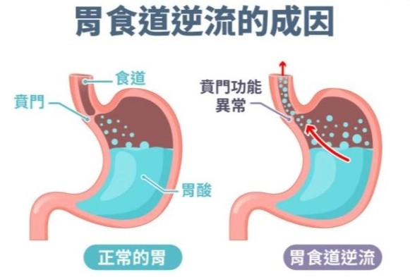 胃食道逆流中醫治療