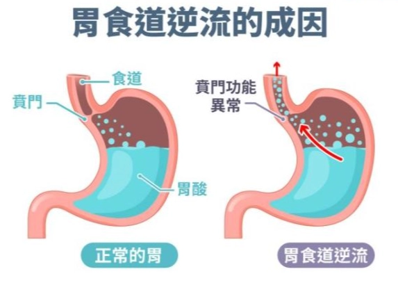 胃食道逆流中醫治療