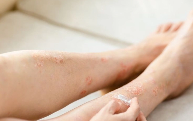 濕疹天然療法 濕疹天然療法