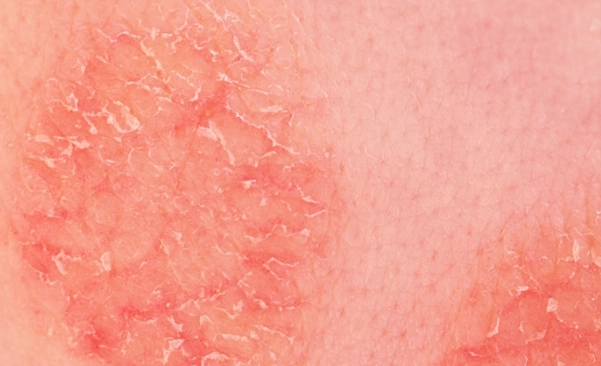 濕疹天然療法 濕疹天然療法