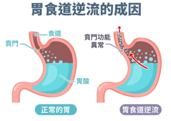 半夏瀉心湯胃食道逆流