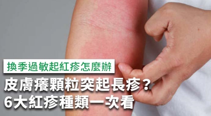 濕疹天然療法 濕疹天然療法