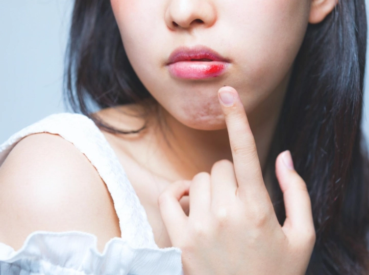 台北嘴破櫻桃 台北嘴破櫻桃