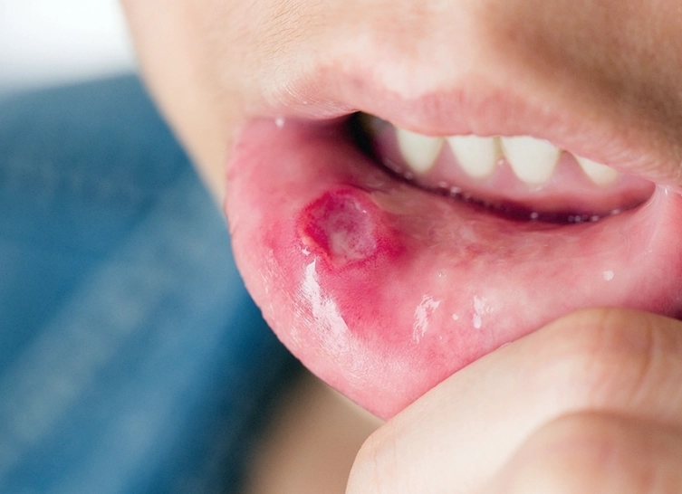 台北嘴破櫻桃 台北嘴破櫻桃