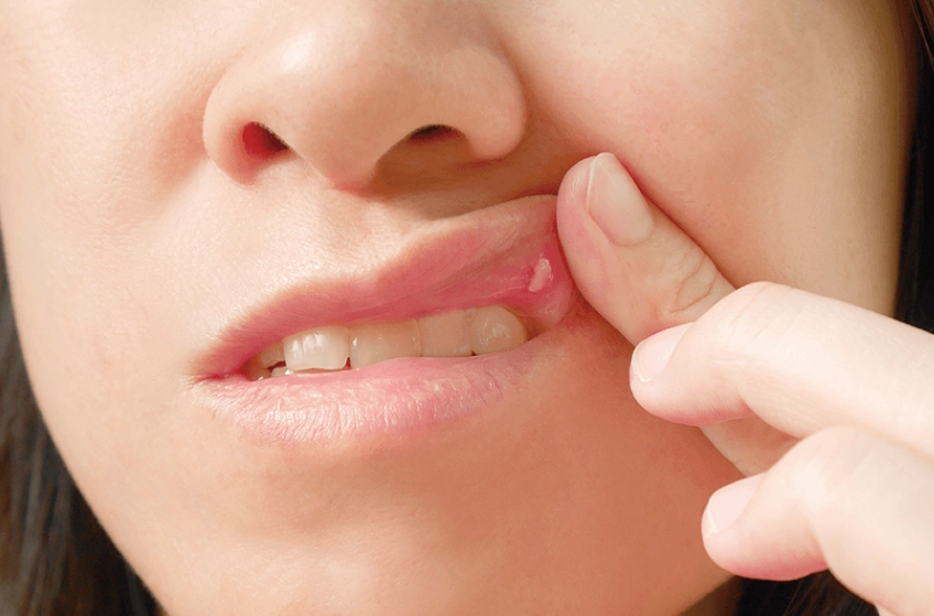 嘴破櫻桃做法 嘴破櫻桃做法