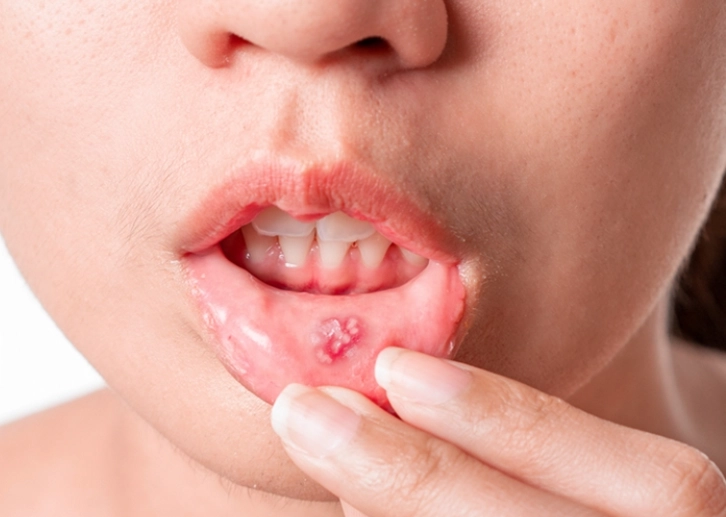 嘴破櫻桃做法 嘴破櫻桃做法