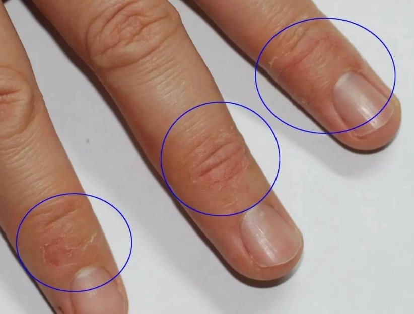 手指脫皮不痛不癢
