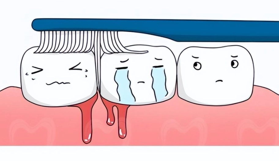牙齦出血原因 牙齦出血原因