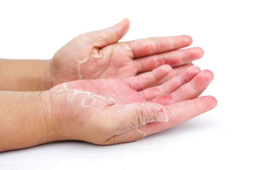 手部皮膚乾燥