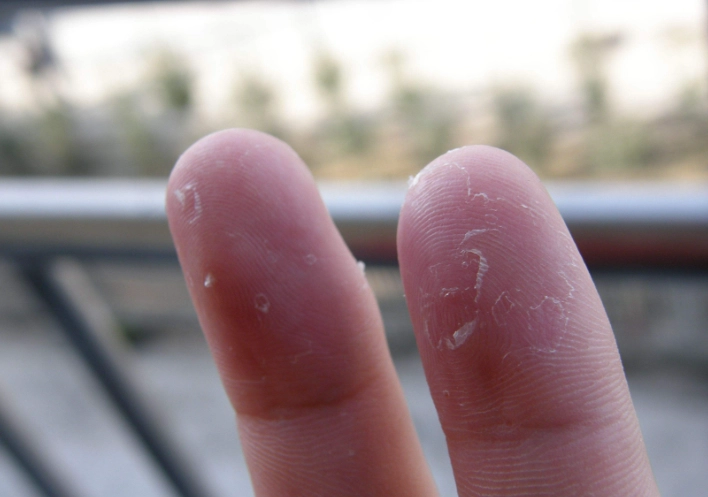 手指脫皮 原因