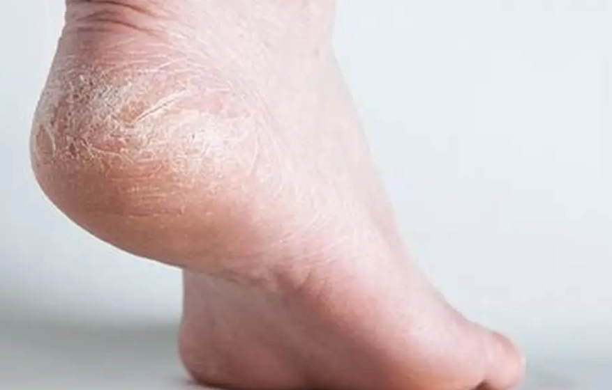 腳底龜裂處理
