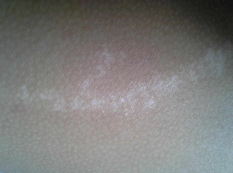 皮膚脫屑怎麼辦