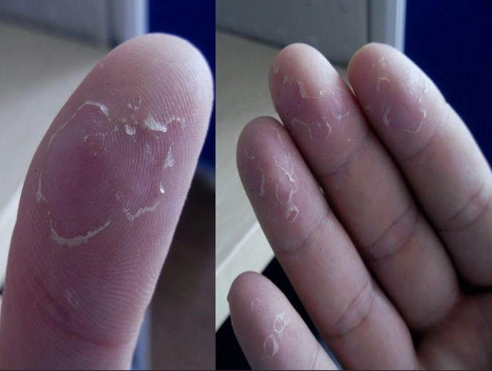 手指脫皮 缺乏 維生素