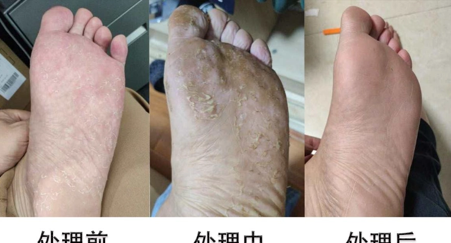 居家足部護理 居家足部護理