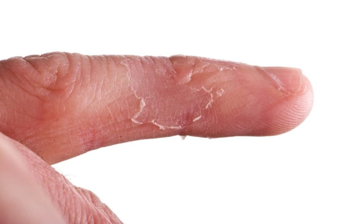 手指脫皮 缺乏 維生素